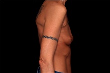 Breast Augmentation Before Photo by Landon Pryor, MD, FACS; Rockford, IL - Case 47463