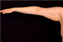 Wave Goodbye to Flabby Arms With an Arm Lift: Joseph Fodero, MD PA: Plastic  Surgery