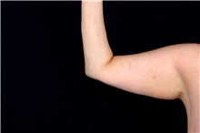 Arm Lift Before Photo by Landon Pryor, MD, FACS; Rockford, IL - Case 47464