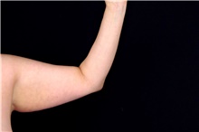 Arm Lift Before Photo by Landon Pryor, MD, FACS; Rockford, IL - Case 47464