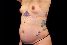 Breast Augmentation Before Photo by Landon Pryor, MD, FACS; Rockford, IL - Case 47465