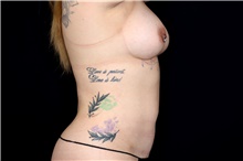 Breast Augmentation After Photo by Landon Pryor, MD, FACS; Rockford, IL - Case 47465