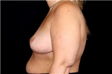 Breast Implant Removal After Photo by Landon Pryor, MD, FACS; Rockford, IL - Case 47467