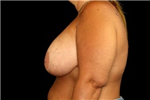 Breast Implant Removal Before Photo by Landon Pryor, MD, FACS; Rockford, IL - Case 47467