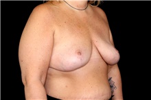 Breast Implant Removal After Photo by Landon Pryor, MD, FACS; Rockford, IL - Case 47467