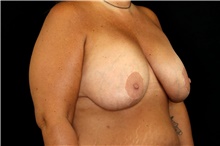 Breast Implant Removal Before Photo by Landon Pryor, MD, FACS; Rockford, IL - Case 47467