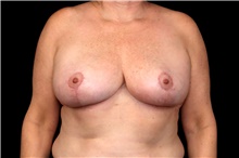 Breast Reduction After Photo by Landon Pryor, MD, FACS; Rockford, IL - Case 47469