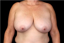 Breast Reduction Before Photo by Landon Pryor, MD, FACS; Rockford, IL - Case 47469
