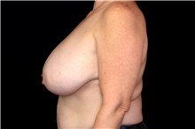 Breast Reduction Before Photo by Landon Pryor, MD, FACS; Rockford, IL - Case 47469
