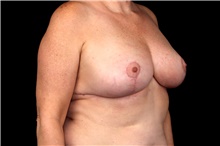 Breast Reduction After Photo by Landon Pryor, MD, FACS; Rockford, IL - Case 47469