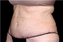 Tummy Tuck After Photo by Landon Pryor, MD, FACS; Rockford, IL - Case 47470