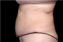 Tummy Tuck After Photo by Landon Pryor, MD, FACS; Rockford, IL - Case 47470