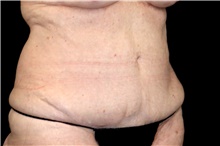 Tummy Tuck Before Photo by Landon Pryor, MD, FACS; Rockford, IL - Case 47470