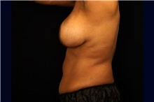 Tummy Tuck Before Photo by Landon Pryor, MD, FACS; Rockford, IL - Case 47472