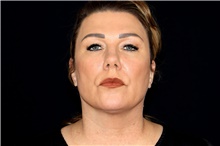 Facelift Before Photo by Landon Pryor, MD, FACS; Rockford, IL - Case 47477