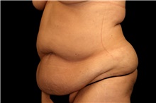 Tummy Tuck Before Photo by Landon Pryor, MD, FACS; Rockford, IL - Case 47479