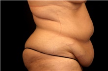 Tummy Tuck Before Photo by Landon Pryor, MD, FACS; Rockford, IL - Case 47479