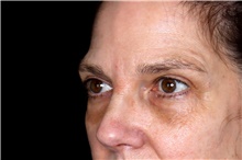Eyelid Surgery After Photo by Landon Pryor, MD, FACS; Rockford, IL - Case 47486