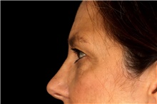 Eyelid Surgery Before Photo by Landon Pryor, MD, FACS; Rockford, IL - Case 47486