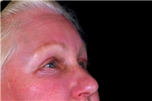 Eyelid Surgery After Photo by Landon Pryor, MD, FACS; Rockford, IL - Case 47487