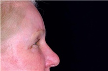 Eyelid Surgery Before Photo by Landon Pryor, MD, FACS; Rockford, IL - Case 47487