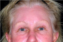 Brow Lift Before Photo by Landon Pryor, MD, FACS; Rockford, IL - Case 47488