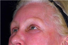 Brow Lift After Photo by Landon Pryor, MD, FACS; Rockford, IL - Case 47488