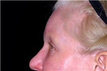 Brow Lift Before Photo by Landon Pryor, MD, FACS; Rockford, IL - Case 47488