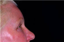 Brow Lift After Photo by Landon Pryor, MD, FACS; Rockford, IL - Case 47488