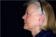 Facelift Before Photo by Landon Pryor, MD, FACS; Rockford, IL - Case 47489