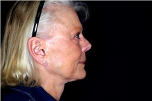 Facelift Before Photo by Landon Pryor, MD, FACS; Rockford, IL - Case 47489
