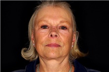 Facelift Before Photo by Landon Pryor, MD, FACS; Rockford, IL - Case 47490