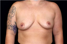 Breast Augmentation Before Photo by Landon Pryor, MD, FACS; Rockford, IL - Case 47493