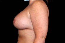 Breast Augmentation After Photo by Landon Pryor, MD, FACS; Rockford, IL - Case 47493