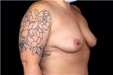 Breast Augmentation Before Photo by Landon Pryor, MD, FACS; Rockford, IL - Case 47493