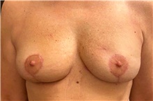 Breast Implant Removal After Photo by Landon Pryor, MD, FACS; Rockford, IL - Case 47494