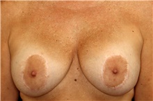 Breast Implant Removal Before Photo by Landon Pryor, MD, FACS; Rockford, IL - Case 47494