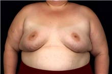 Breast Augmentation After Photo by Landon Pryor, MD, FACS; Rockford, IL - Case 47532