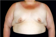 Breast Augmentation Before Photo by Landon Pryor, MD, FACS; Rockford, IL - Case 47532