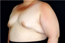 Breast Augmentation Before Photo by Landon Pryor, MD, FACS; Rockford, IL - Case 47532