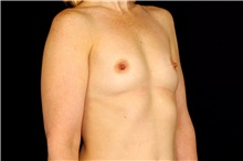 Breast Augmentation Before Photo by Landon Pryor, MD, FACS; Rockford, IL - Case 47534