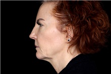 Facelift Before Photo by Landon Pryor, MD, FACS; Rockford, IL - Case 47535