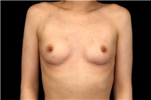 Breast Augmentation Before Photo by Landon Pryor, MD, FACS; Rockford, IL - Case 47543