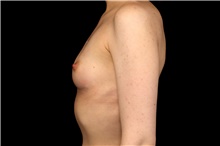 Breast Augmentation Before Photo by Landon Pryor, MD, FACS; Rockford, IL - Case 47543