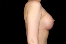 Breast Augmentation After Photo by Landon Pryor, MD, FACS; Rockford, IL - Case 47543