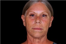Facelift Before Photo by Landon Pryor, MD, FACS; Rockford, IL - Case 47544