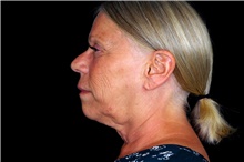 Facelift Before Photo by Landon Pryor, MD, FACS; Rockford, IL - Case 47544
