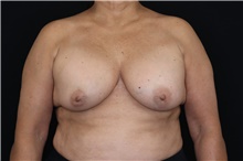 Breast Implant Removal Before Photo by Landon Pryor, MD, FACS; Rockford, IL - Case 47547
