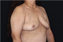 Breast Implant Removal After Photo by Landon Pryor, MD, FACS; Rockford, IL - Case 47547