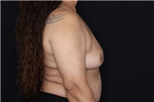 Breast Implant Removal After Photo by Landon Pryor, MD, FACS; Rockford, IL - Case 47547